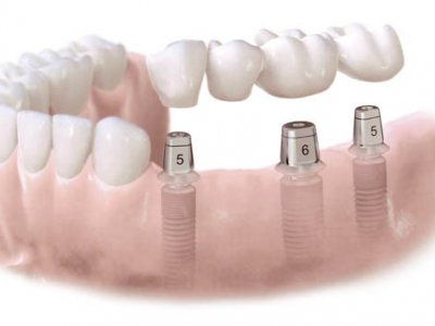 Thủ tục cấp chứng nhận đủ điều kiện hành nghề dịch vụ răng, hàm giả. (Mức 1)
