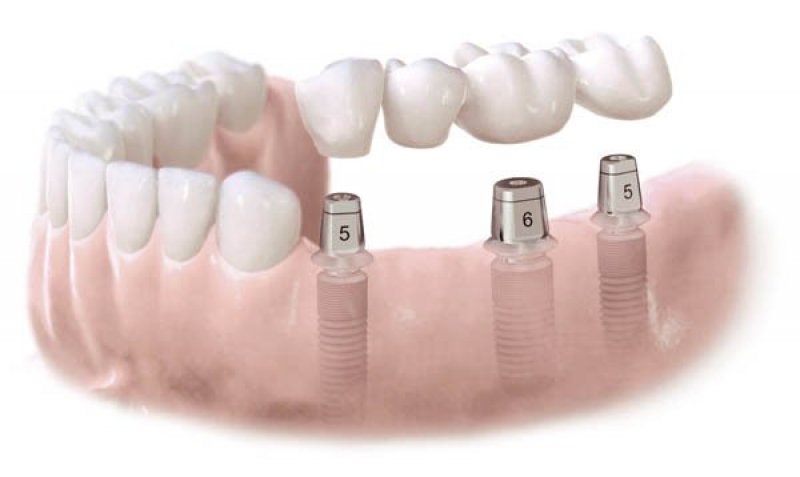 Thủ tục cấp chứng nhận đủ điều kiện hành nghề dịch vụ răng, hàm giả. (Mức 1)